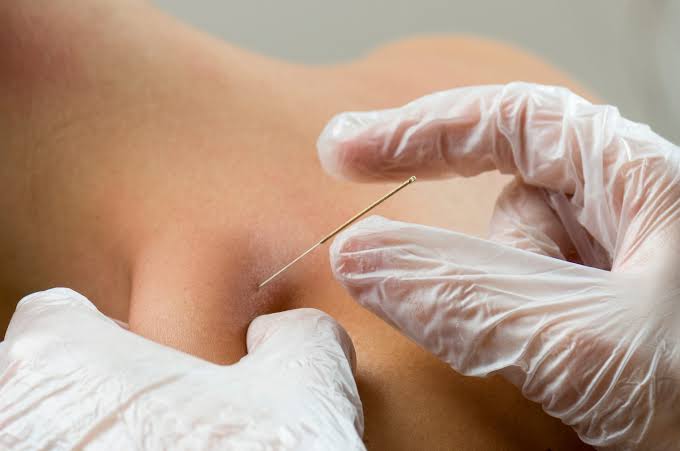 Dry Needling